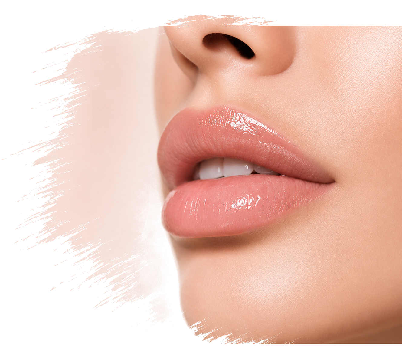 Diamond Lips lip filler results